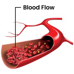 Opening Up Blood Flow